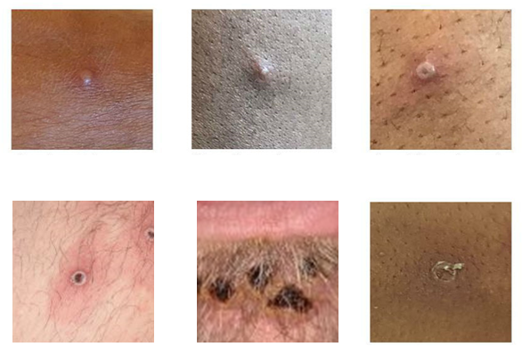 Monkeypox is spreading but the Ohio Department of Health hasn’t spread the message