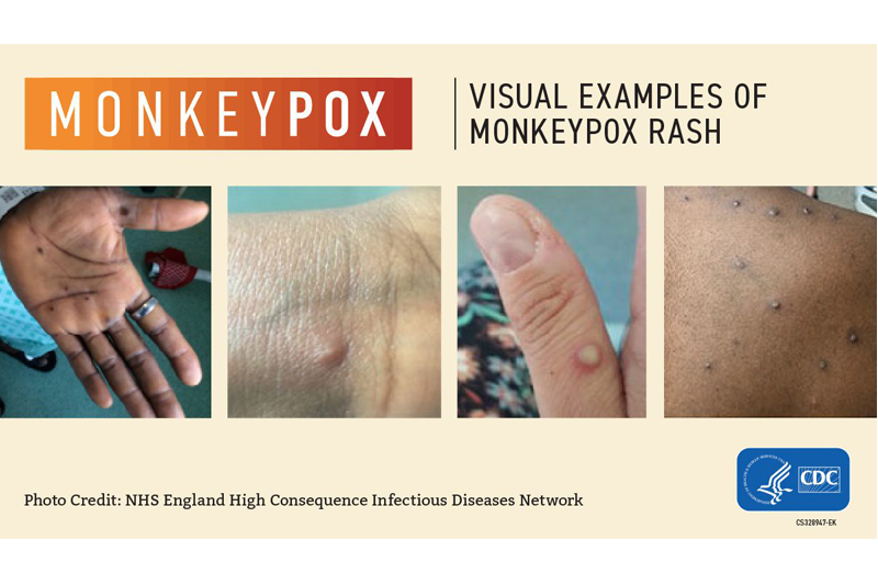 Current guidance and information about Monkeypox in Hamilton County